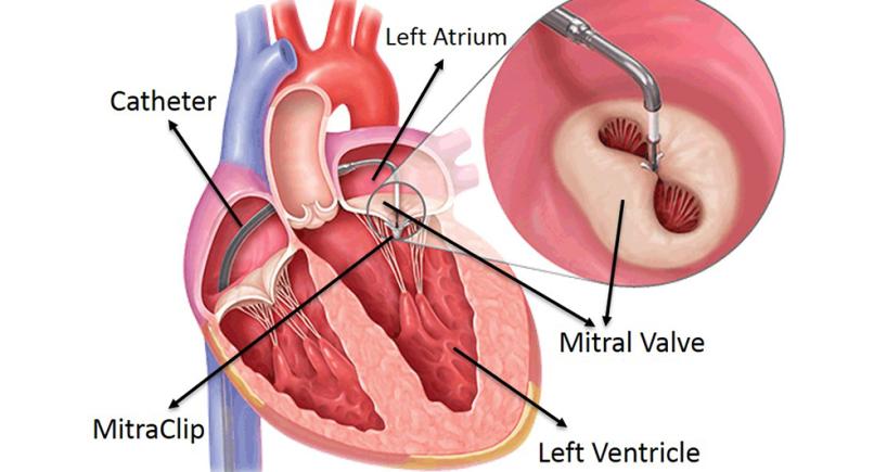 Heart valve repair without open heart surgery performed for the first time in India at Fortis Escorts Heart Institute