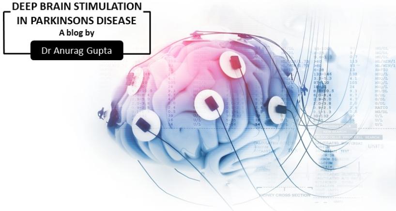 Deep Brain Stimulation In Parkinsons Disease