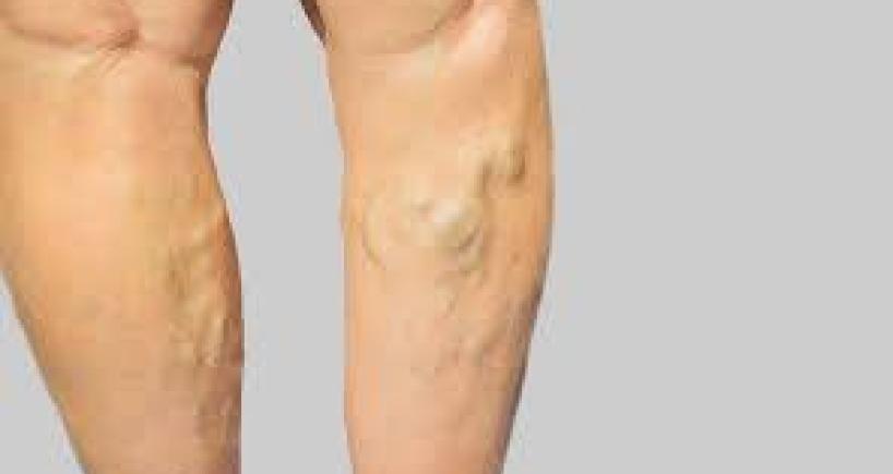 Varicose Veins